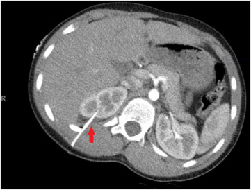 Fig. 3. CT scan demonstrating a 5.3 cm right flank foreign body (red arrow) penetrating the kidney with a grade 1 sub-capsular kidney hematoma.
